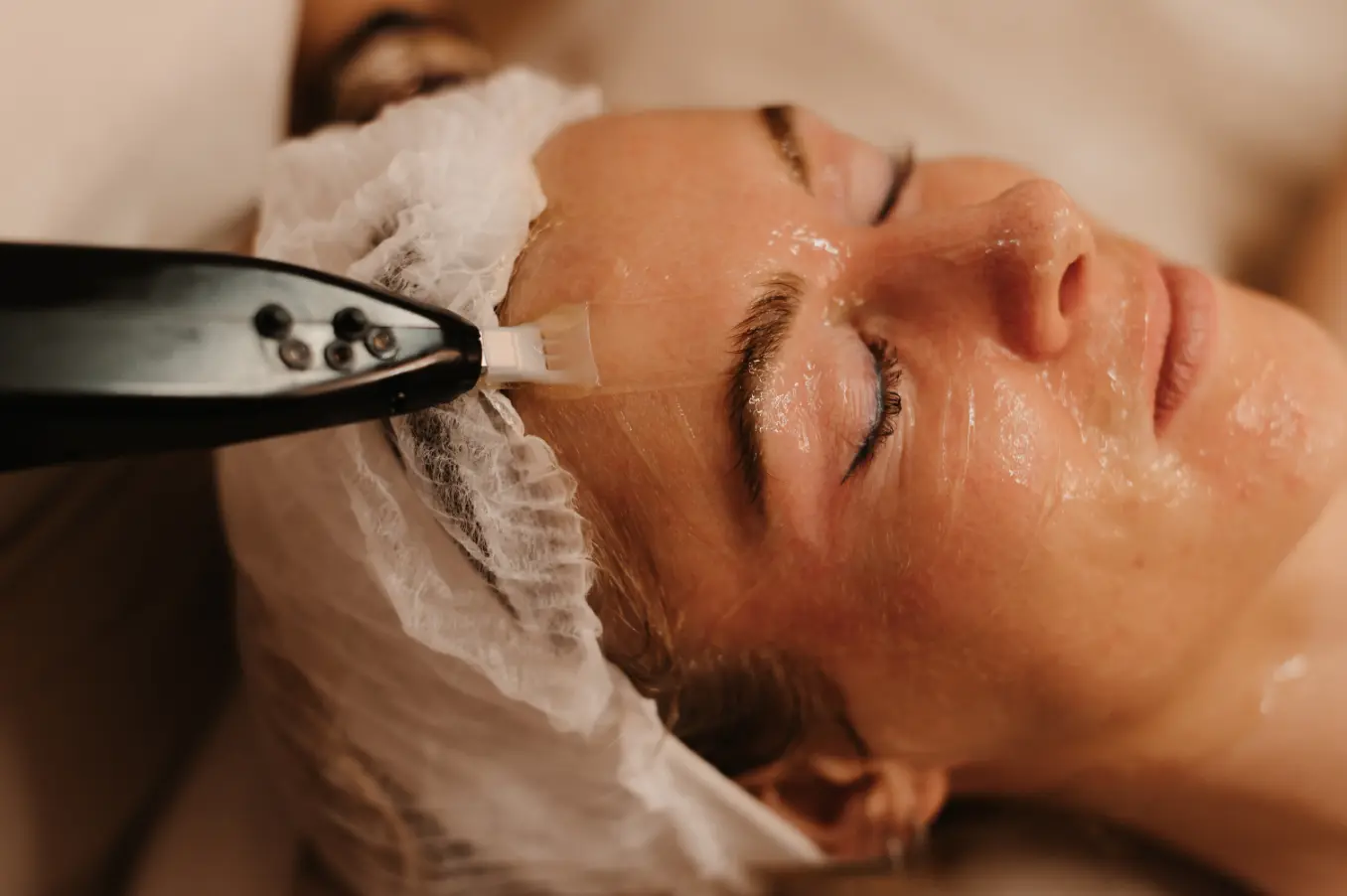 Cell Story Liquid Microneedling behandeling van Delica Derma.